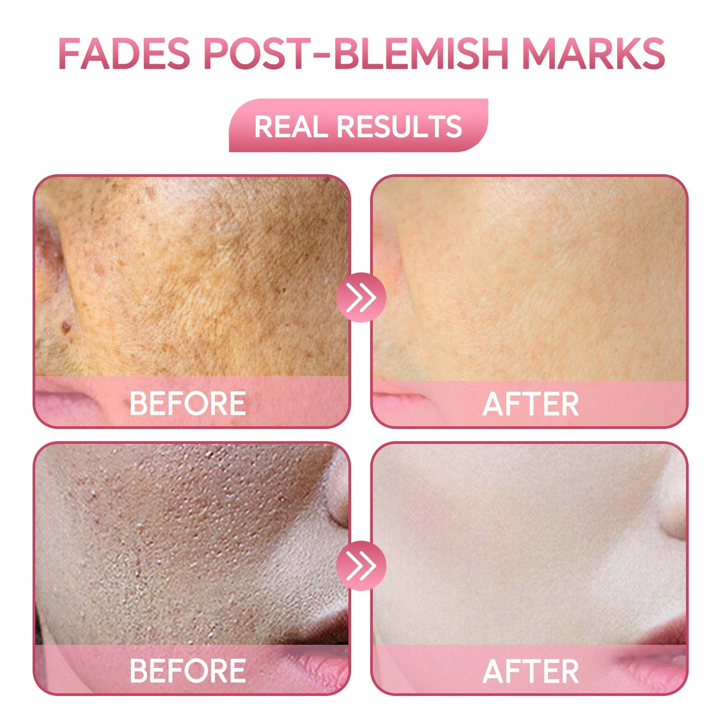 Treatments and results of Vitamin B3 niacinamide serum